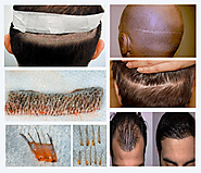 FUHT Follicular Unit Hair Transplant in Sai Cosmetics