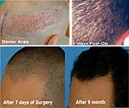 FUE Hair Transplant in Pune by Sai Cosmetics
