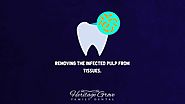 The Process of Root Canal Plainfield IL Dentists Follow