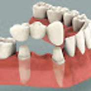 American Dental Lab: Crowns and bridges made in US