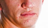 5 Tips for Reducing Acne Scars