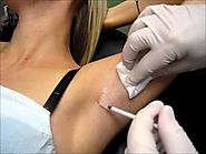 Side Effects of Botox Surgery for Underarm Sweating