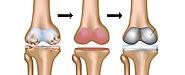 How Long does It Take to Recover from Total Knee Replacement Surgery? - Joint Replacement & Arthroscopy Center