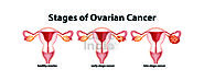 Website at https://www.cureindia.com/treatments/ovarian-cancer