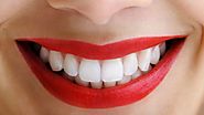 Blanquear los dientes: Lo que debería saber antes