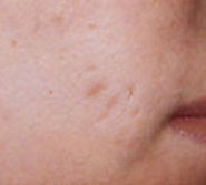 Treatment of Acne Scars in Charlotte NC