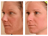 Halo by SCITON | Dermatology Specialists of Charlotte
