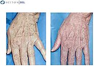 Hand Rejuvenation | Dermatology Specialists of Charlotte