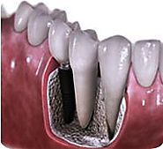 Dental Implants Greensborough | Greensborough Plaza Dental