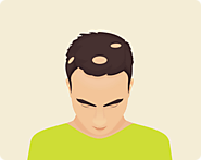 Alopecia Areta - The Balding Condition