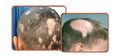 The advancement of hair loss is totally unpredictable, why not take the help of Ayurveda! – ayurvedichaircare
