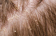 How To Treat Seborrheic Dermatitis in India By Ayurveda