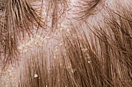 Ayurvedichaircare — How To Treat Seborrheic Dermatitis in India By...