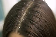 Remedies To Avoid Seborrheic Dermatitis in India