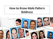 How to Know Male Pattern Baldness
