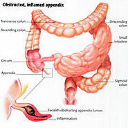 Appendix Removal Surgery in Chennai | Appendicitis Treatment India