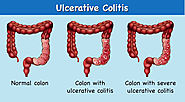 Ulcerative Colitis Treatment In India |Colitis Ulcerosa Diagnose