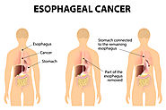 Esophagus Cancer Treatment In Chennai, India | Surgery for Esophagus Cancer
