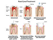 Best Root canal in Melbourne | Prahran Family Dental 