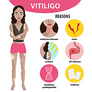 Vitiligo Therapy India | Treatment for Skin Disease India | Leucoderma Delhi