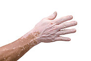 Skin Grafting Procedure India | Remedy for Vitiligo New Delhi | Treatment for White Patches Delhi