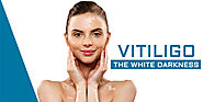 Skin Pigmentation Care | Vitiligo Disease Specialist India | Best Dermatology Doctor New Delhi