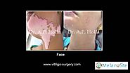 Advanced Treatment For Vitiligo Delhi | Melanocyte Transplantation | Best Skin Treatment in India