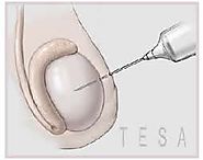Testicular Aspiration Kochi | TESA Infertility Treatment India