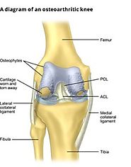 Knee Replacement Surgeon in Indore