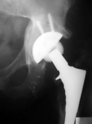 Revision Hip Replacement Surgeon in Indore