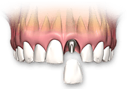 Everything You Need To Know About Dental Veneers - Anil Jain - Medium