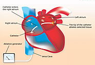 Treatment for Abnormal Heart Rhythm | Cardiac Ablation | Best Cardiologist in Gurgaon