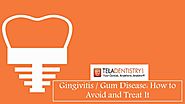 Gingivitis / Gum Disease: How to Avoid and Treat It