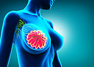 جراحة استئصال سرطان الثدي | دكتور وائل شعلان