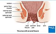 Dr. Butler’s treatment for anal fissures