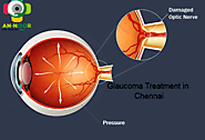 Glaucoma Treatment in Chennai