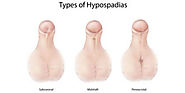 CAN HYPOSPADIAS CORRECT ON ITS OWN? MEDICAL TREATMENT CENTRE