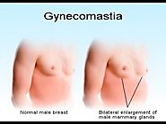 Gynecomastia Treatment