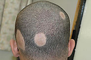 Alopecia Hair Transplant – Vue pk