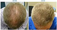 PRP Treatment For Hair loss