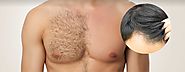 Body Hair Transplant