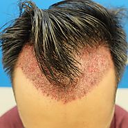 FUE Hair Transplant - Hair Transplant