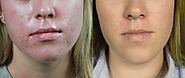 Acne treatment in the Dallas area | Dr. Ellen Turner