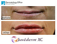 Juvéderm® dermal filler | Dermatologist Dr. Ellen Turner in the Dallas Area