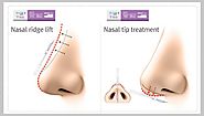 Two Significant Methods of Human Nose Thread Lift Treatment