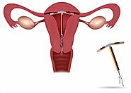 Progesterone IUD vs Copper IUD: Which One to Choose?