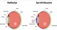 Glaucoma Eye Treatment In India