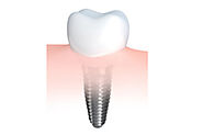 Dentist Modesto | Implant Dentist Modesto | Emergency Dentist Modesto
