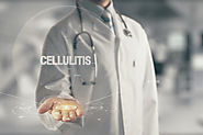What Causes Cellulitis?
