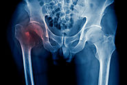 Broken Bones Versus Fractures: Which Is Worse?